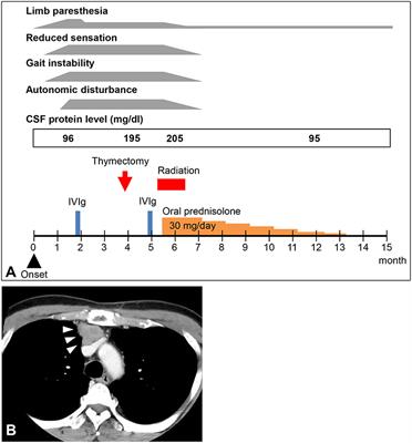 Subacute Sensory Ataxic Neuronopathy With Thymoma Presenting Marked Improvement After Steroid Therapy